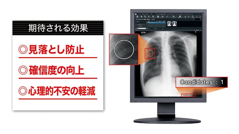 胸部レントゲンAI診断支援システム 期待される効果